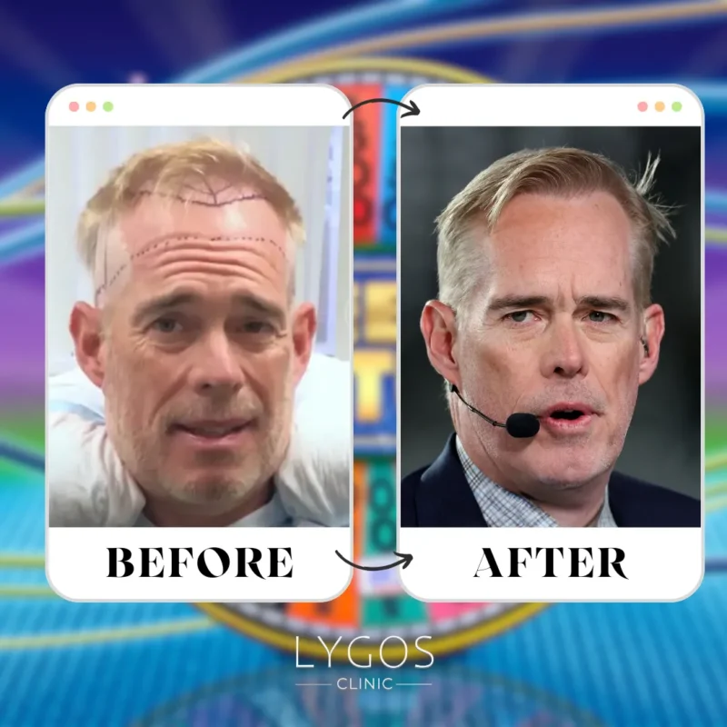 Joe Buck Hair Transplant