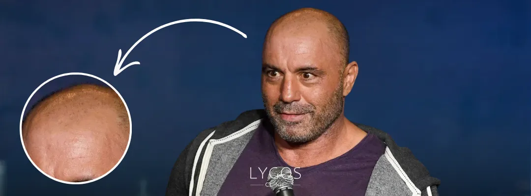 Joe Rogan Saç Dökülmesi