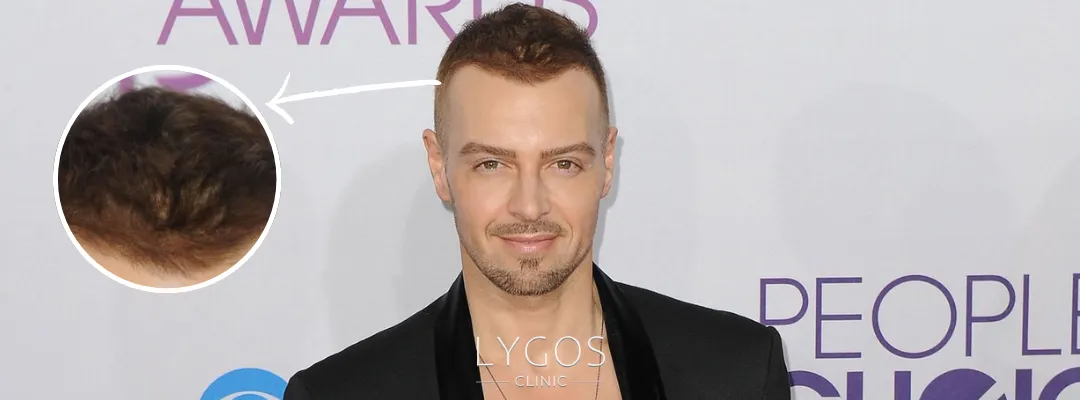 Joey Lawrence Saç Dökülmesi