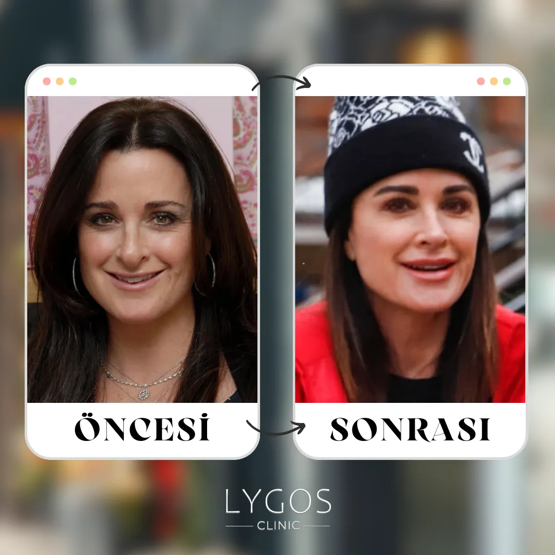 Kyle Richards Burun Estetiği | Ünlülerde Burun Estetiği 1 Kyle Richards Burun Estetiği