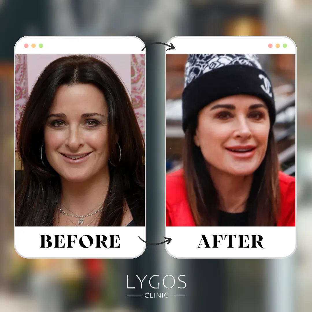 Kyle Richards Rhinoplasty | Celebrities Nose Job 1 Kyle Richards Rhinoplasty