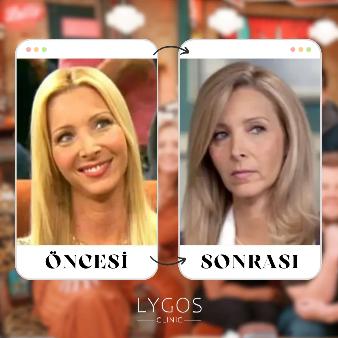 Lisa Kudrow Burun Estetiği | Ünlülerde Burun Estetiği 1 Lisa Kudrow Burun Estetiği