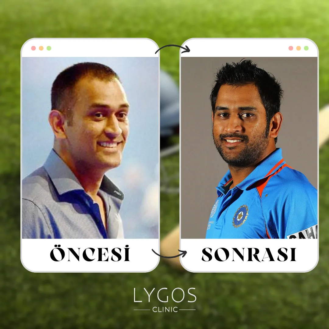 Mahendra Singh Dhoni Saç Ekimi | Öncesi ve Sonrası 1 Mahendra Singh Dhoni Saç Ekimi