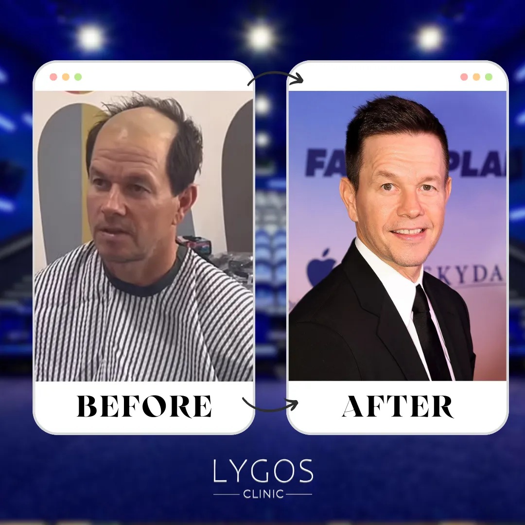 Mark Wahlberg Hair Transplant | Before and After 1 Mark Wahlberg Hair Transplant
