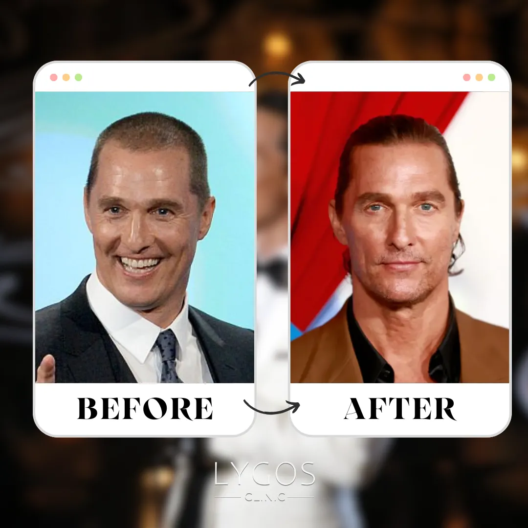 Matthew McConaughey Hair Transplant | Before and After 1 Matthew McConaughey Hair Transplant
