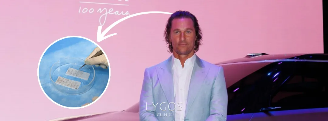 Matthew McConaughey İçin Kaç Saç Grefti Ekildi?