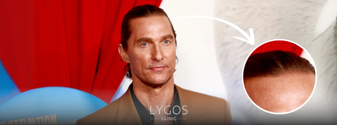 Matthew McConaughey Saç Ekimi Yaptırdı mı?