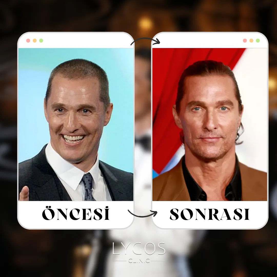 Matthew McConaughey Saç Ekimi