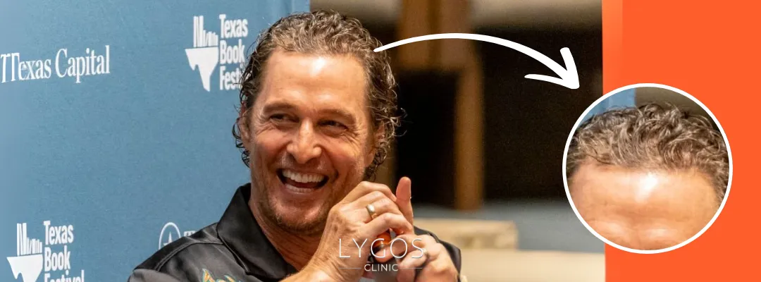 Matthew McConaughey'nin Saç Dökülmesi