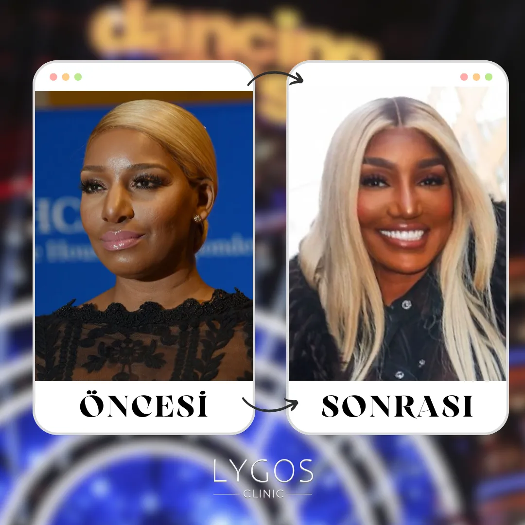 NeNe Leakes Burun Estetiği | Ünlülerde Burun Estetiği 1 nene leakes burun estetigi