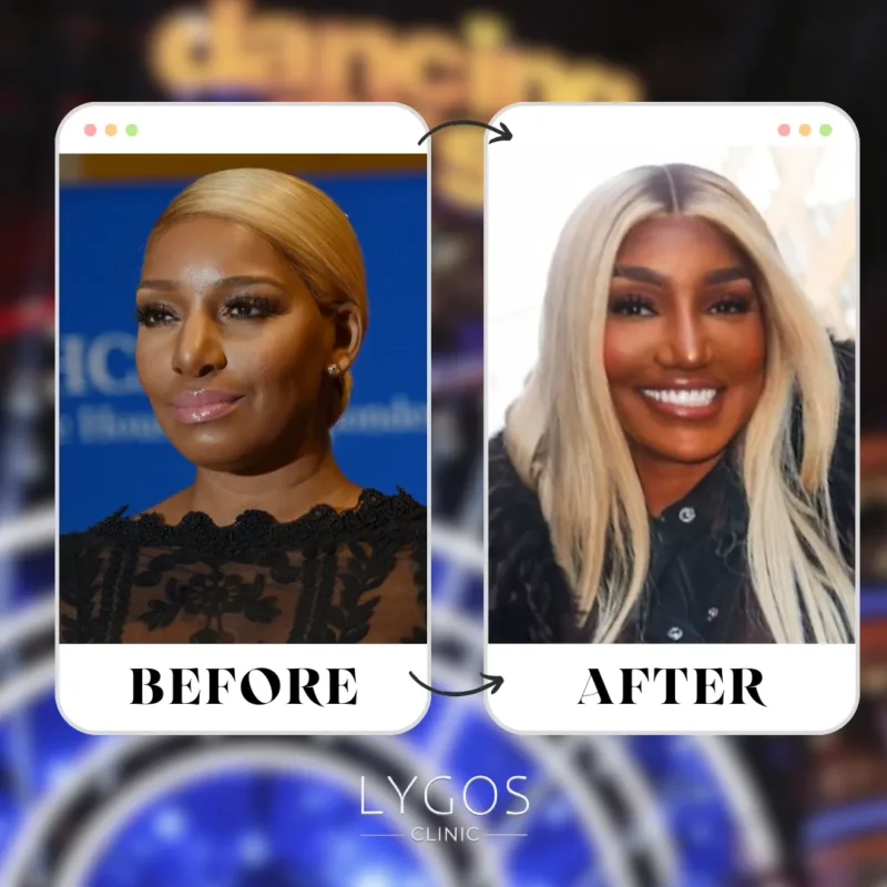 NeNe Leakes Rhinoplasty