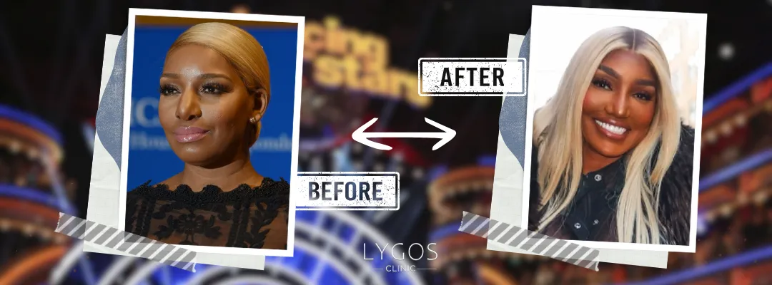 NeNe Leakes Rhinoplasty Before and After