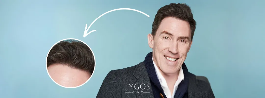 Rob Brydon Saç Ekimi Yaptırdı mı?