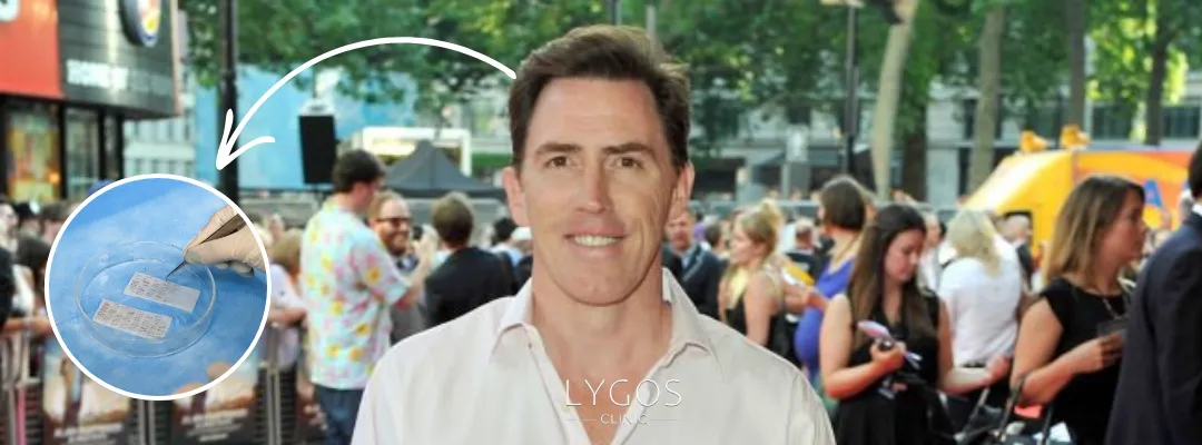 Rob Brydon’a Kaç Graft Saç Ekimi Yapıldı?