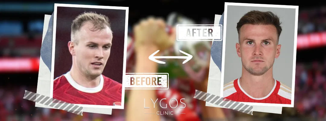 Rob Holding Before and After Hair Transplant