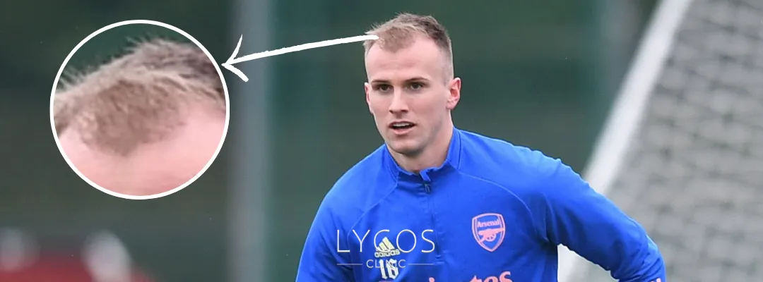 Rob Holding Hair Loss