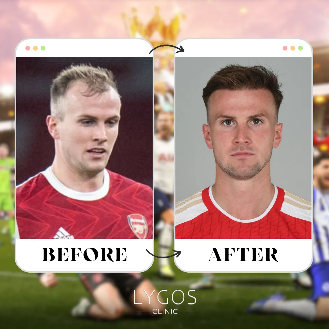 Rob Holding Hair Transplant