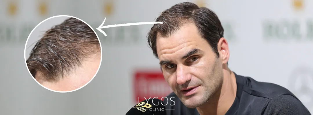 Roger Federer Saç Dökülmesi