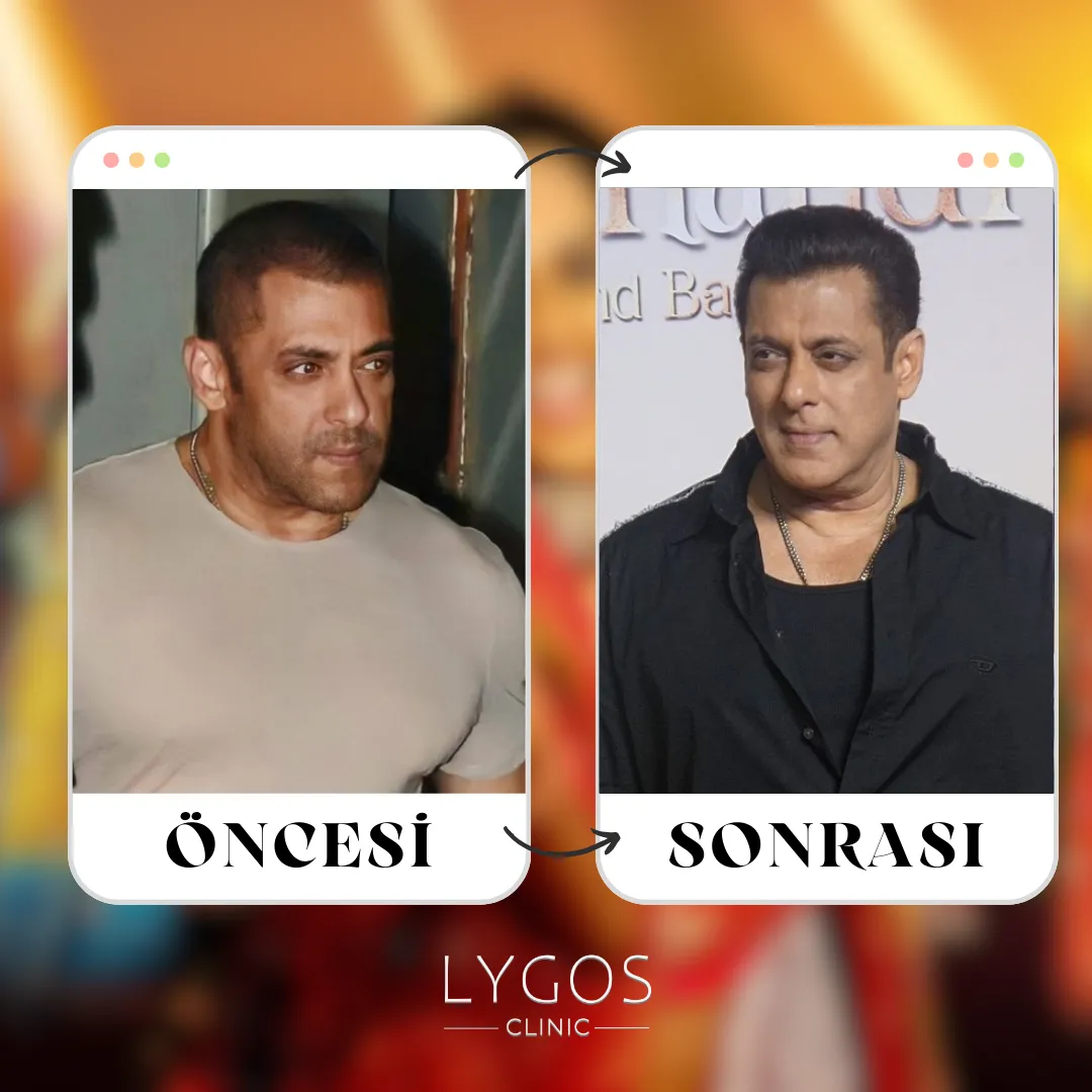 Salman Khan Saç Ekimi | Öncesi ve Sonrası 1 Salman Khan Saç Ekimi