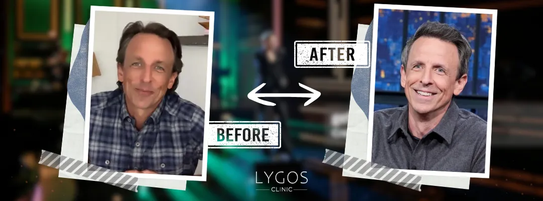 Seth Meyers Before and After Hair Transplant