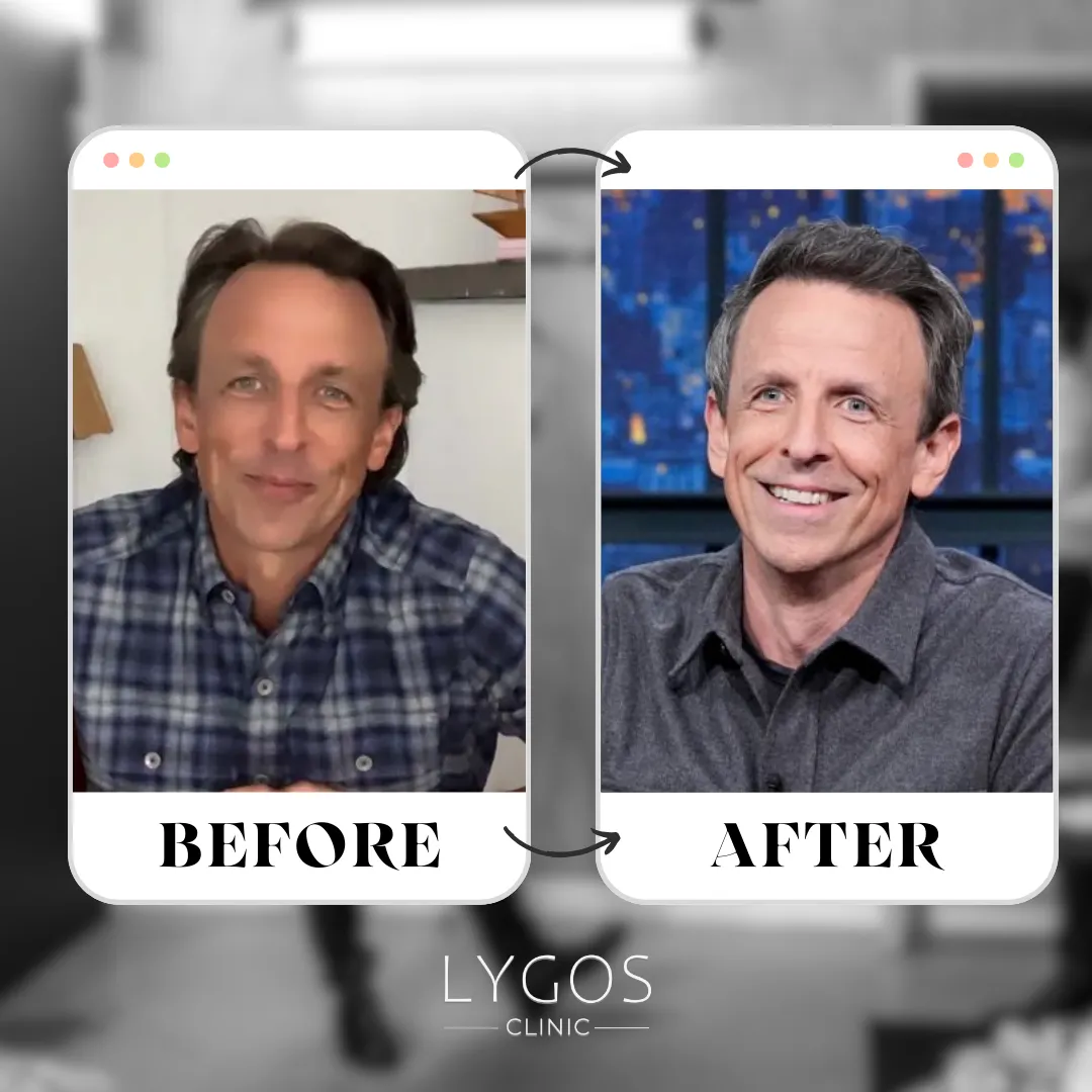 Seth Meyers Hair Transplant | Celebrities Hair Transplant 1 Seth Meyers Hair Transplant