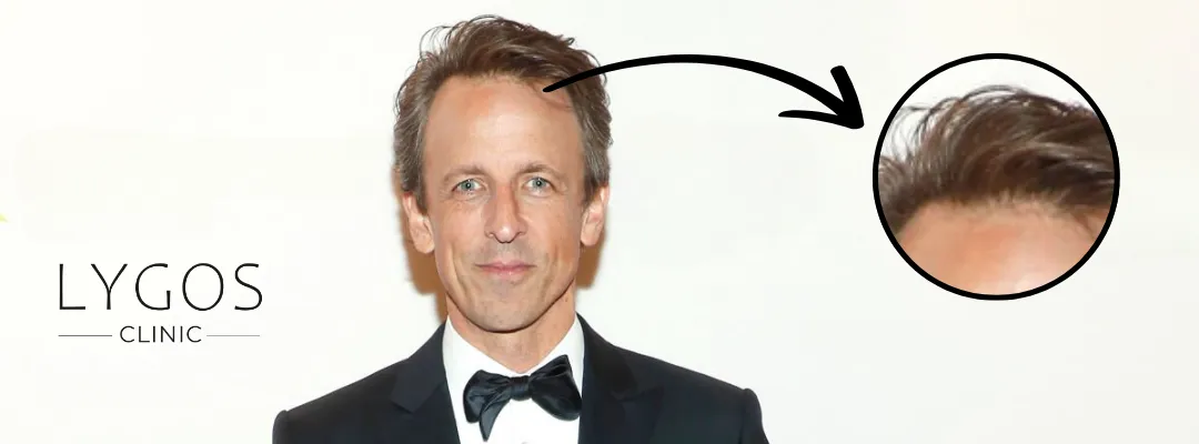 Seth Meyers Saç Dökülmesi