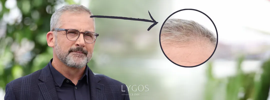 Steve Carell Hair Loss