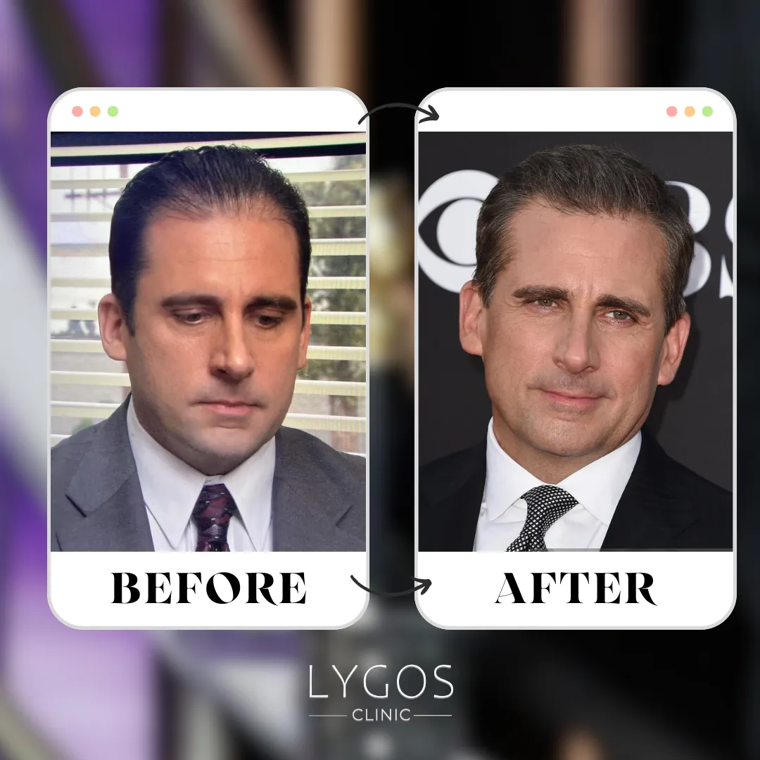 Steve Carell Hair Transplant | Celebrities Hair Transplant 1 Steve Carell Hair Transplant