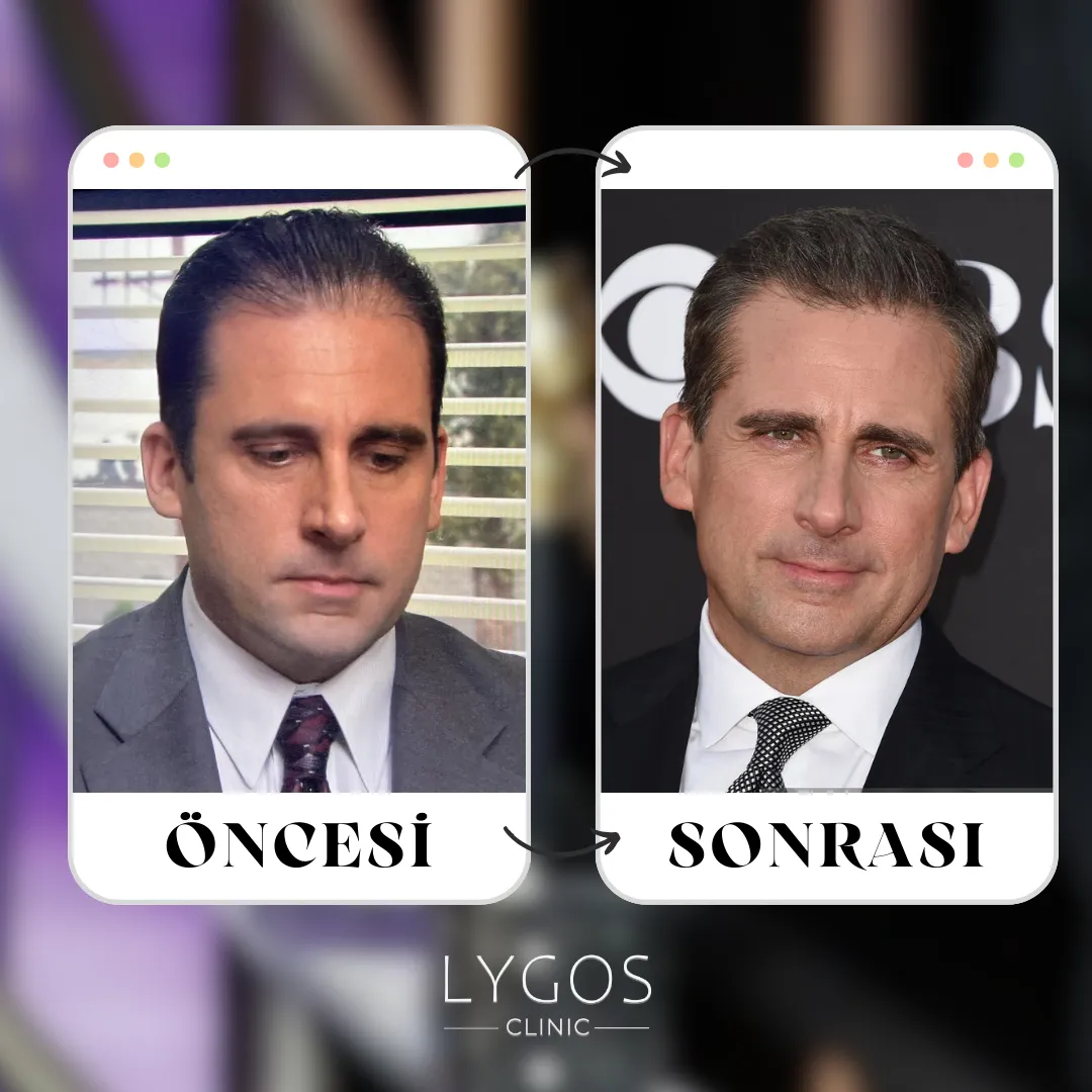 Steve Carell Saç Ekimi | Ünlülerde Saç Ekimi 1 Steve Carell Saç Ekimi