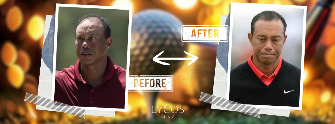 Tiger Woods Before and After Hair Transplant