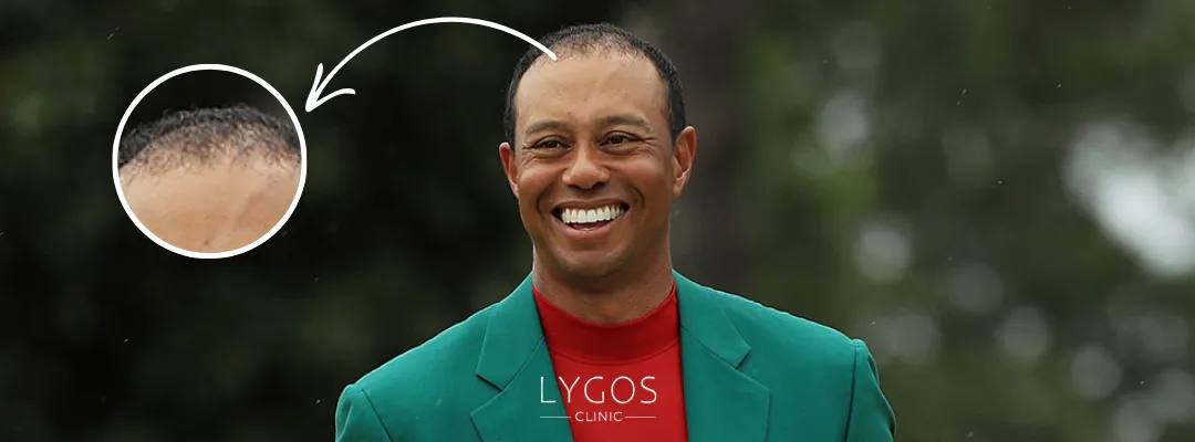 Tiger Woods Saç Dökülmesi