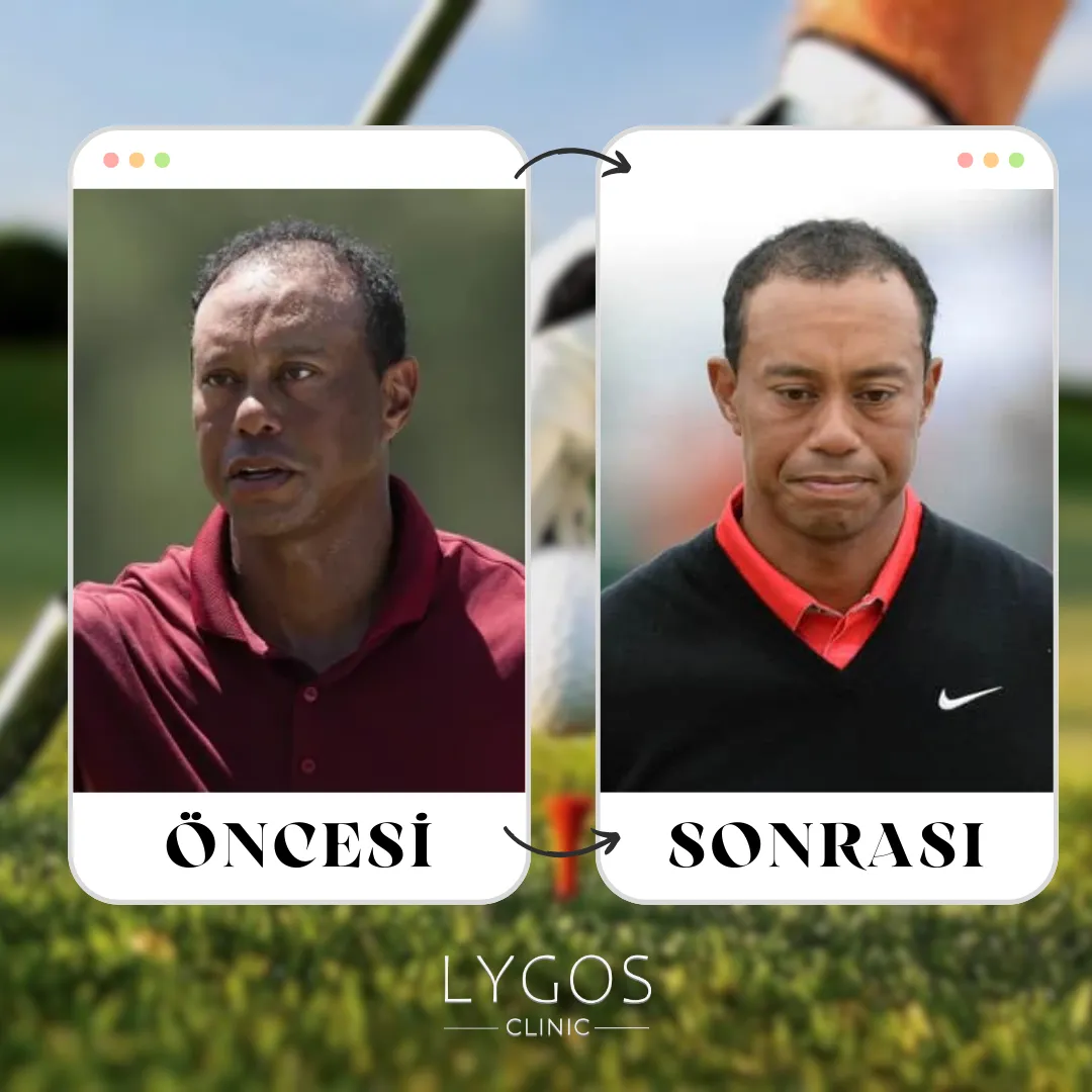 Tiger Woods Saç Ekimi | Öncesi ve Sonrası 1 Tiger Woods Saç Ekimi