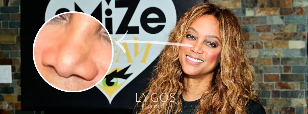 Tyra Banks Burun Estetiği Yaptırdı mı?