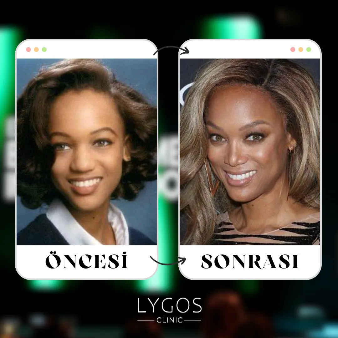 Tyra Banks Burun Estetiği