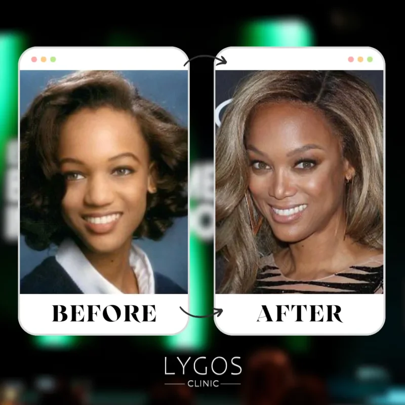 Tyra Banks Rhinoplasty