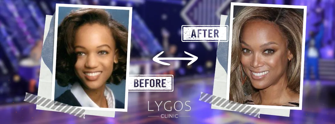 Tyra Banks Rhinoplasty | Celebrities Nose Job 6 Tyra Banks Rhinoplasty Before and After