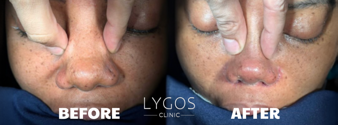Wide Nose Aesthetic Surgery | How to Fix a Wide Nose 3 Before and After Wide Nose Aesthetic Surgery