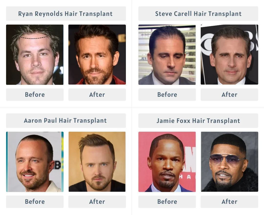 Celebrities Hair Transplants | Before and After 2 celebrities-hair-transplant-before-and-after