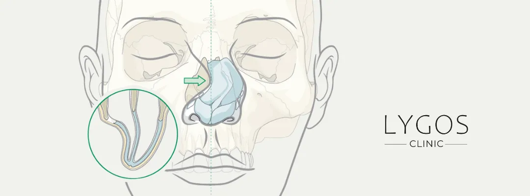 Why Do Pain and Swelling Occur in the Nasal Bone? 2 Common Causes of Pain and Swelling in the Nasal Bone