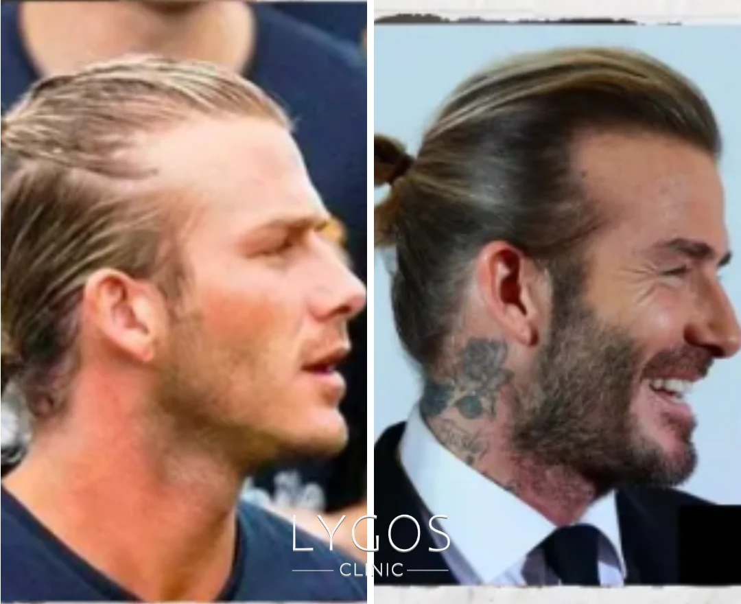 Saç Ekimi Yaptıran Ünlüler | Öncesi ve Sonrası 37 David Beckham Hair Transplant Celebrities