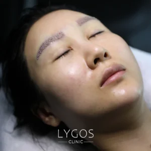 Eyebrow Transplant 18 Eyebrow Transplant Aftercare and Tips