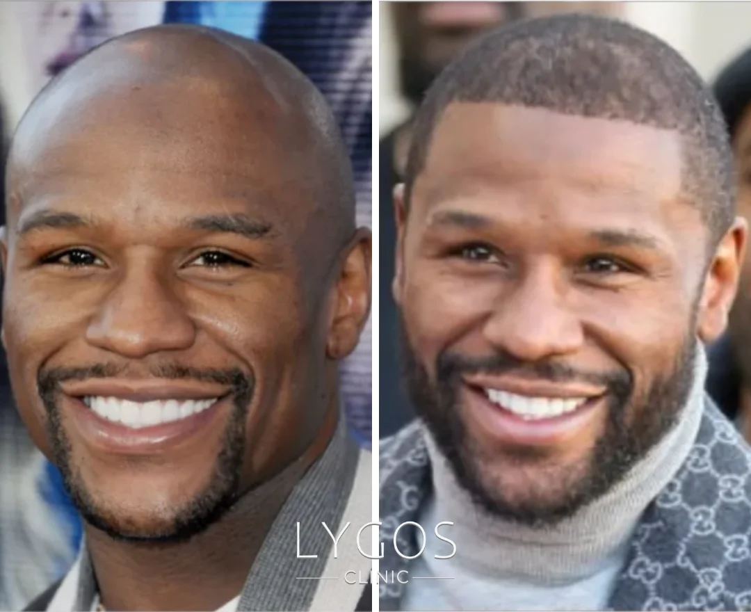 Saç Ekimi Yaptıran Ünlüler | Öncesi ve Sonrası 36 Floyd Mayweather Jr Hair Transplant