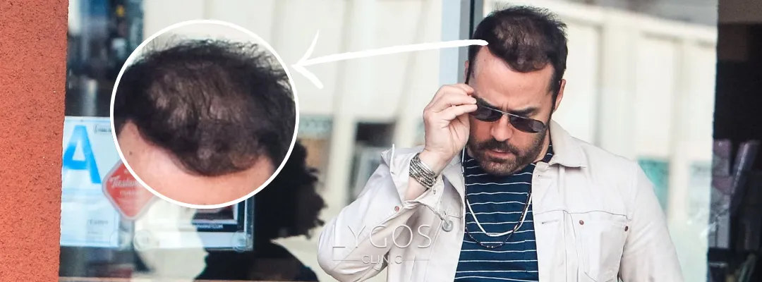 Jeremy Piven Saç Ekimi | Ünlülerde Saç Ekimi 2 Jeremy Piven Saç Dökülmesi