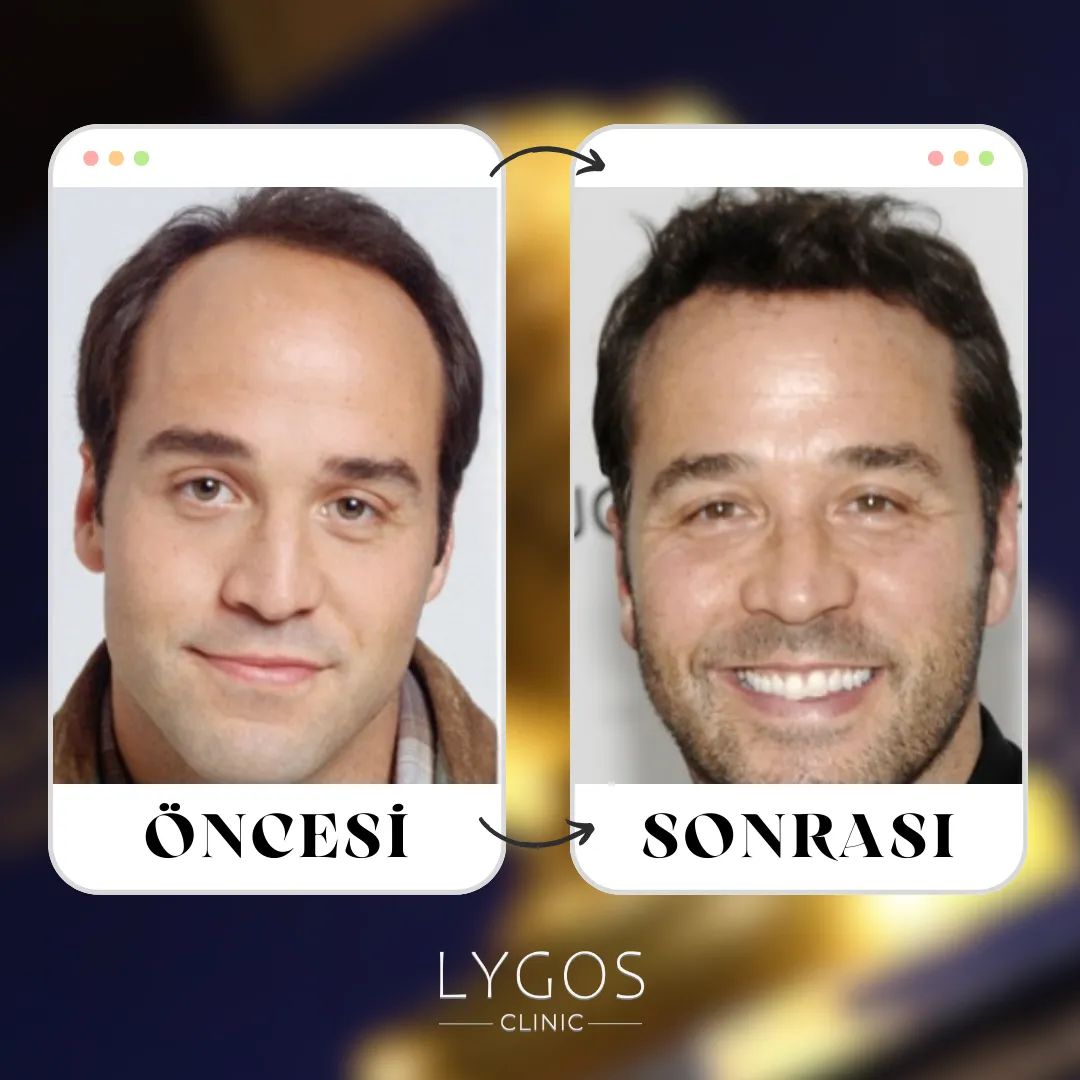 Jeremy Piven Saç Ekimi | Ünlülerde Saç Ekimi 1 Jeremy Piven Saç Ekimi