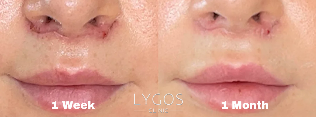 Lip Lift Surgery | Risks and Recovery 4 Lip Lift Surgery Recovery Process