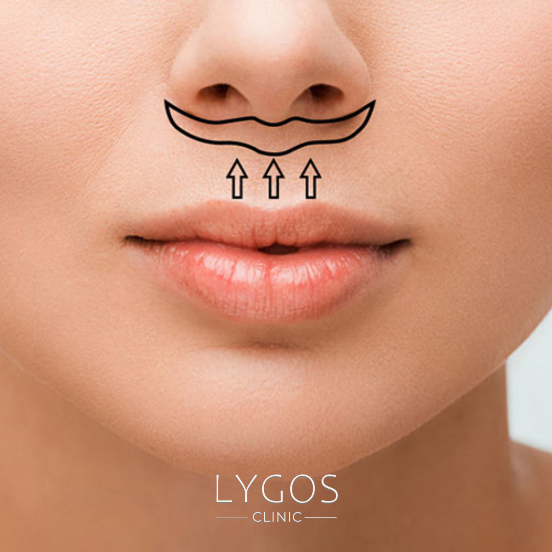 Lip Lift Surgery | Risks and Recovery 1 Lip Lift Surgery