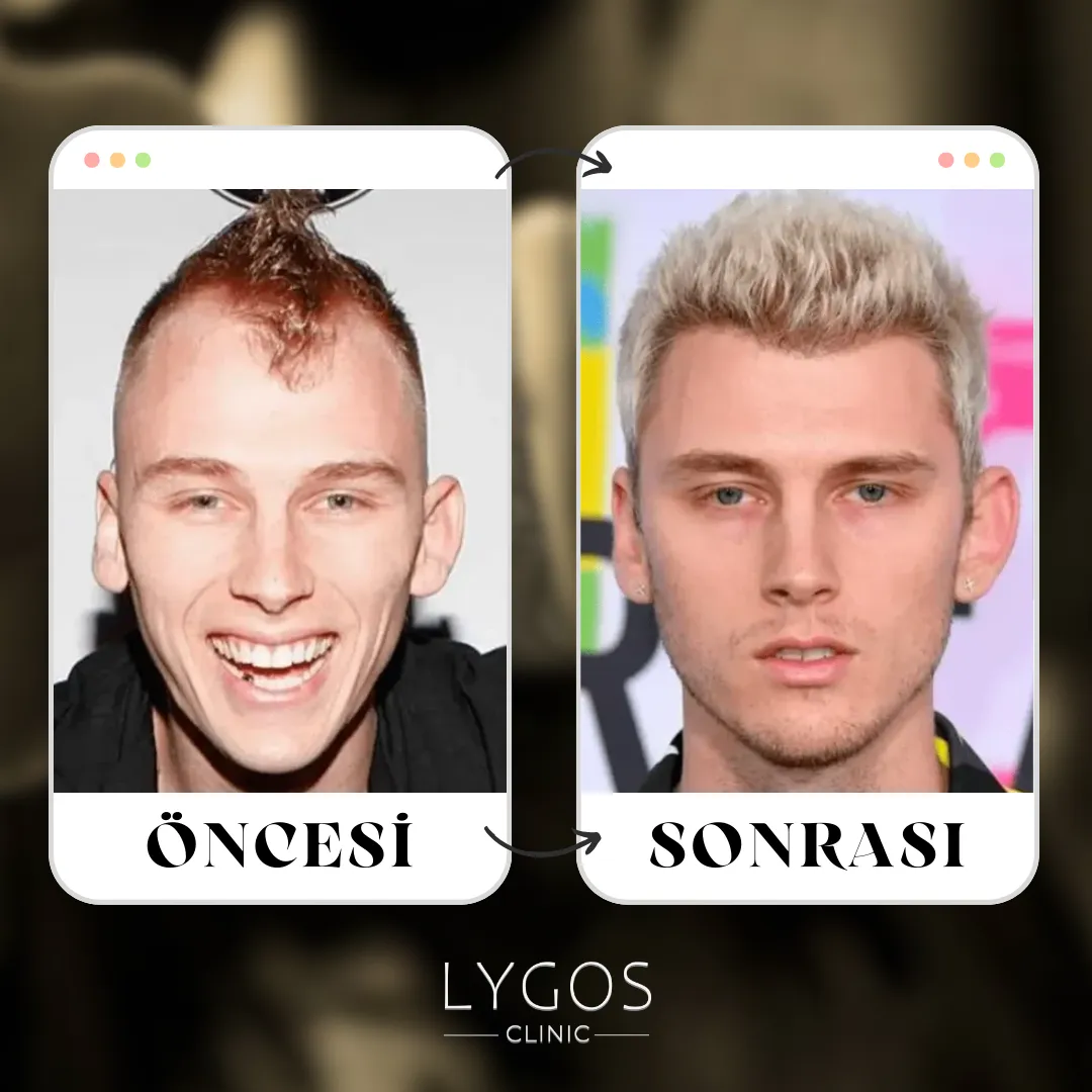 Machine Gun Kelly Saç Ekimi | Öncesi ve Sonrası 1 Machine Gun Kelly Saç Ekimi