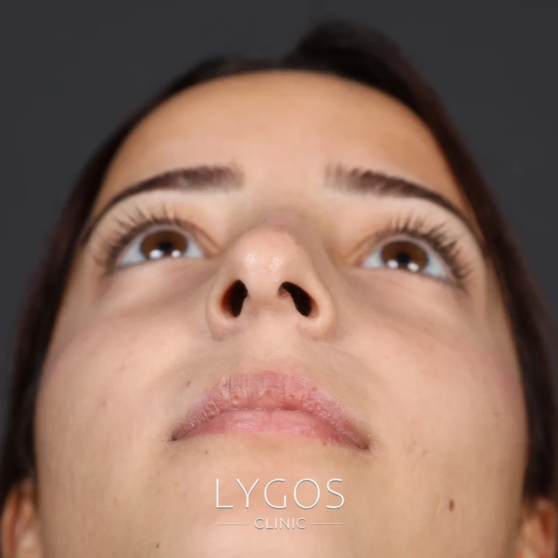 Nostril Asymmetry Issue After Rhinoplasty