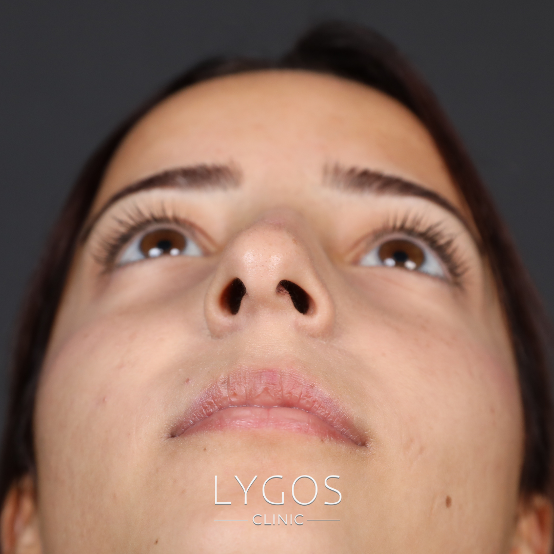 Nostril Asymmetry Issue After Rhinoplasty 1 Nostril Asymmetry Issue After Rhinoplasty