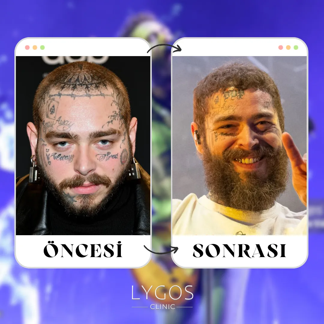 Post Malone Saç Ekimi